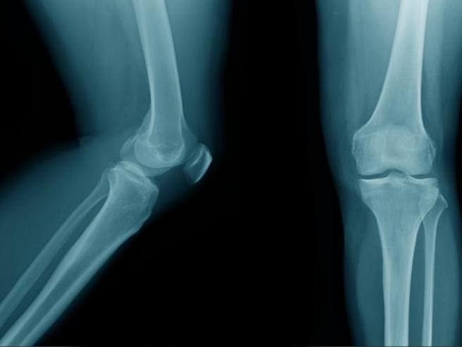 Metastasi ossee per 35mila italiani ogni anno: cosa si può